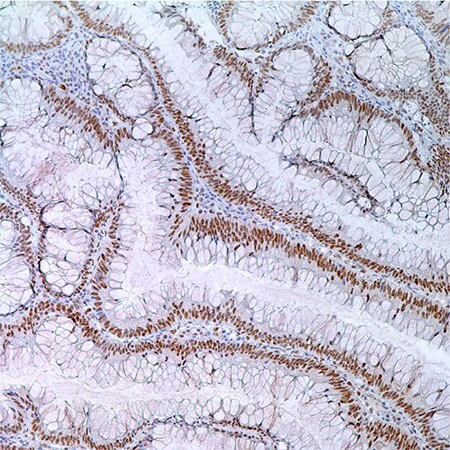 MLH1 (G168-728) in colonic adenoma in 55 year old male; nuclear labeling of adenoma cells