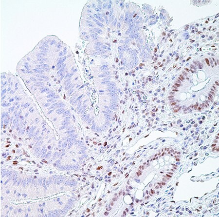 PMS2 (EPR3947†)– Note the normal nuclear labeling of the crypt epithelial cells 